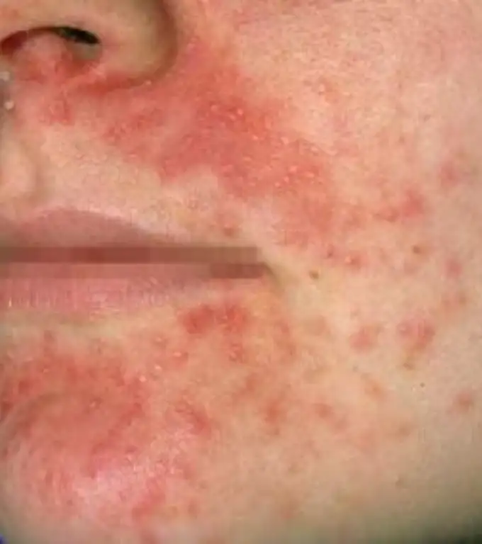 Perioral Dermatitis